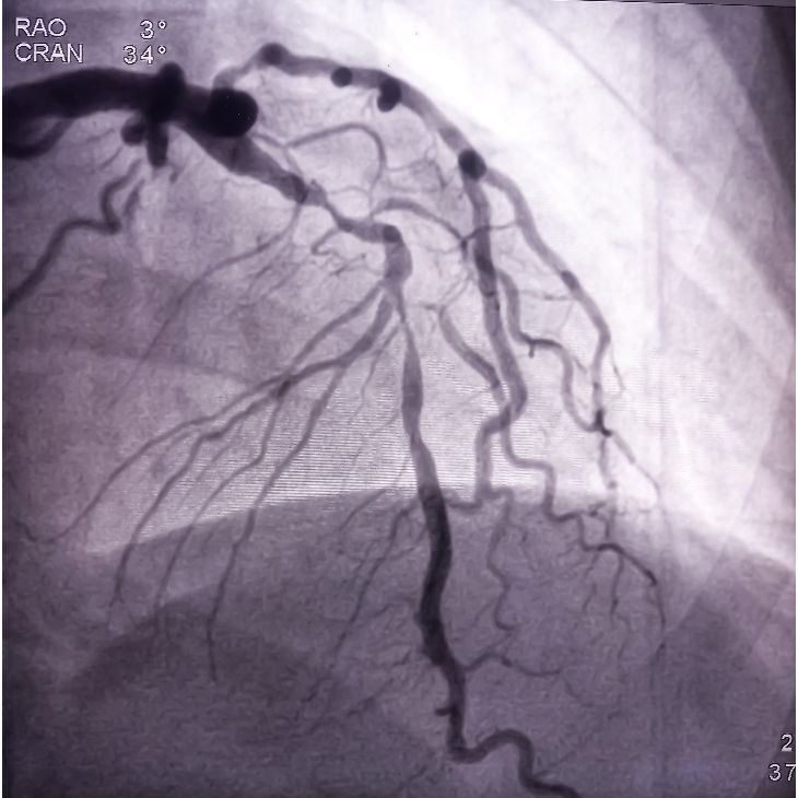 angiography-dr-sayan-sen-follow-up