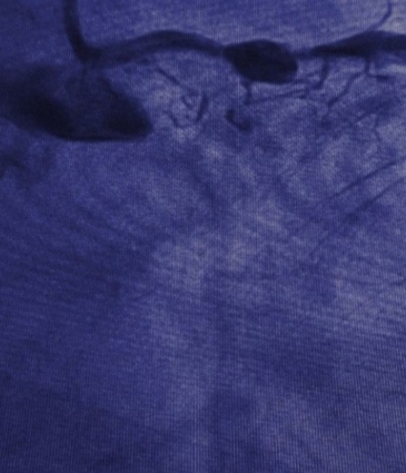 dr-sayan-sen-angiography-featured