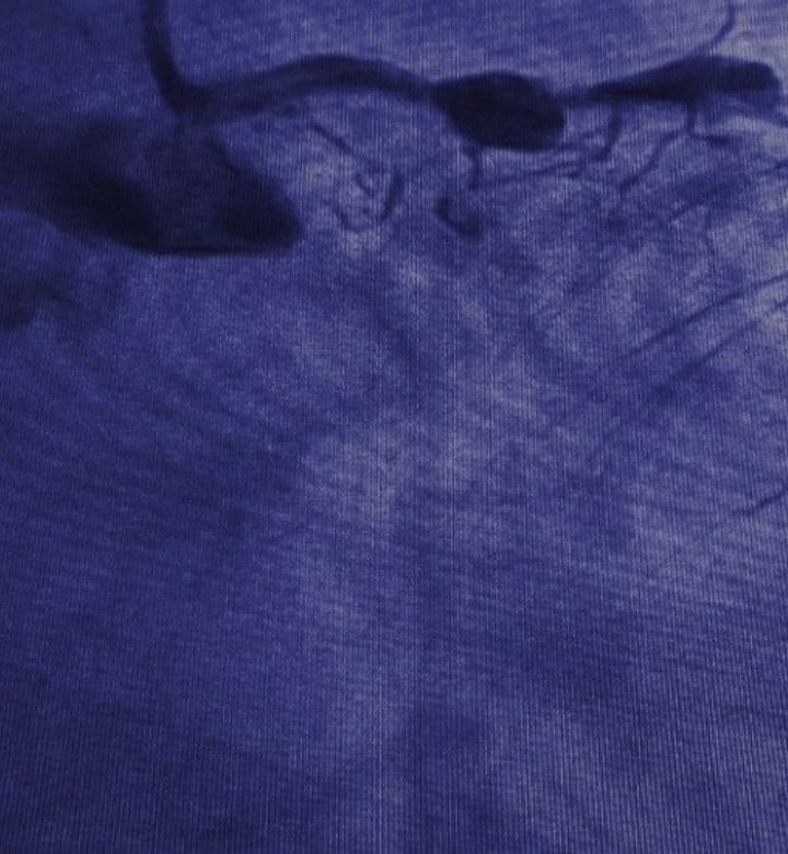 dr-sayan-sen-angiography-featured